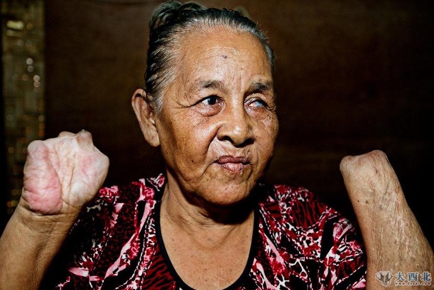 巴瑶族老妇伊布·哈尼萨，在使用自制化肥炸弹炸鱼时因炸弹提前爆炸失去了双手和一只眼睛。